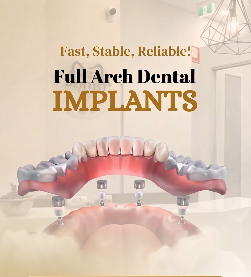 Sample dental practice post: Full arch implants