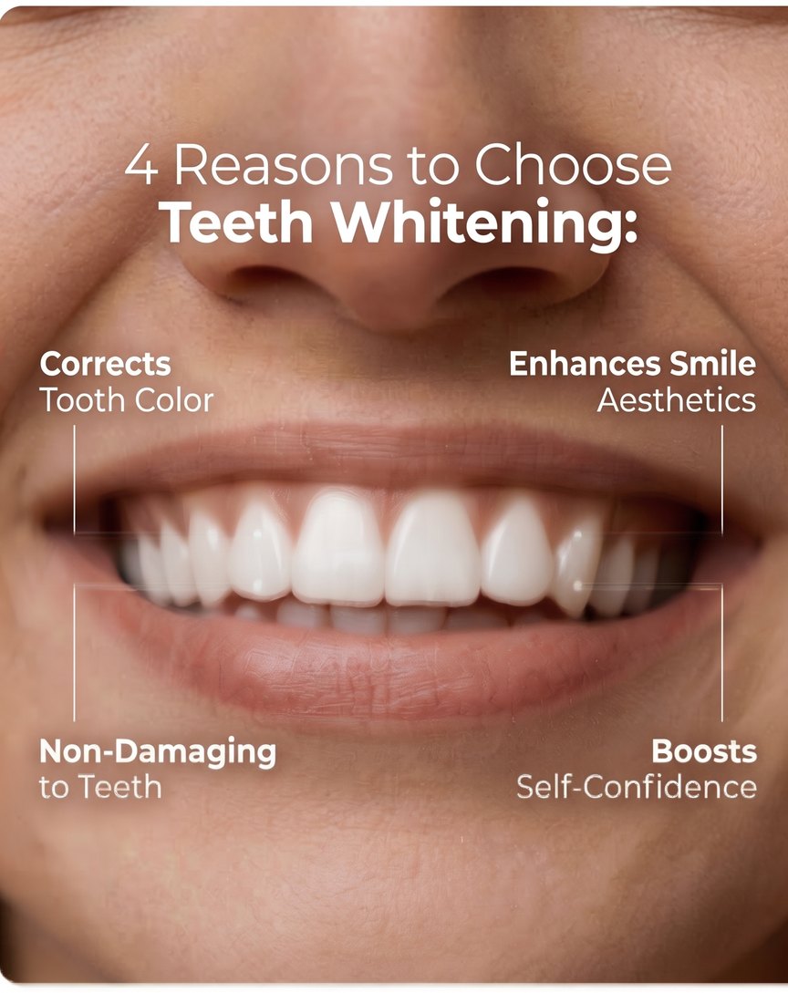 Sample Facebook post: Whitening (4 reasons)